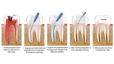 Wurzelbehandlung